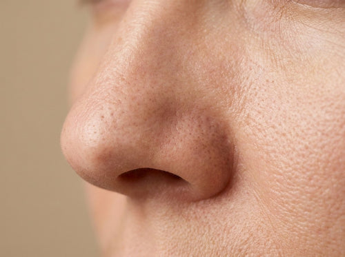 Enlarged Pores