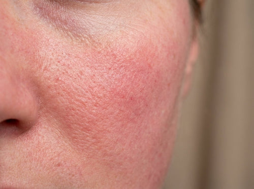 Redness & Sensitivity