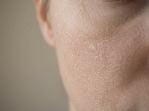 Dryness & Dehydration