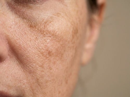 Dark Spots & Pigmentation